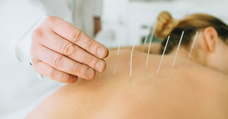 acupuncture